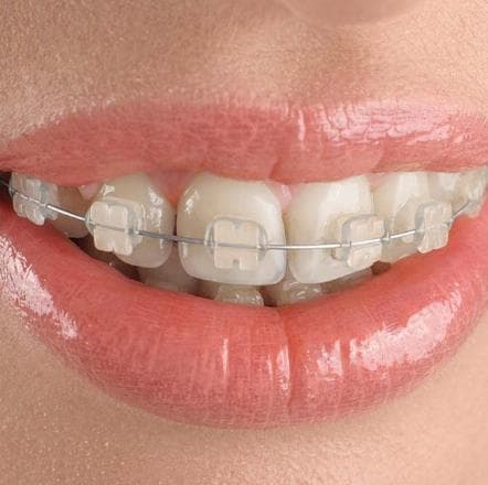 Mascherine trasparenti denti