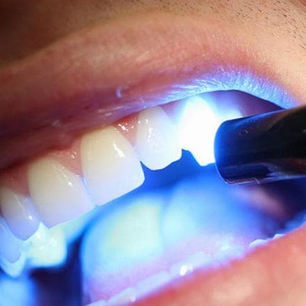 Sbiancamento dei denti con il laser