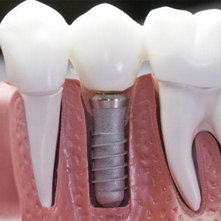 Inserimento degli impianti con moncone e corona in metallo-ceramica