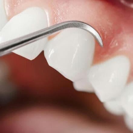 Trattamento parodontale completo