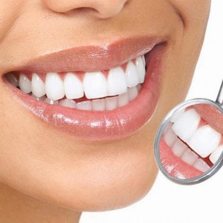 Faccette in composito realizzate in laboratorio