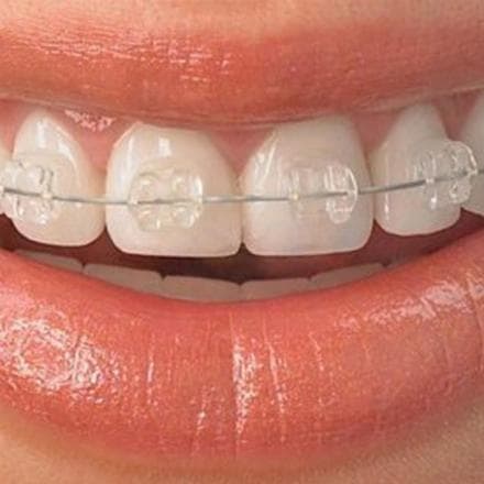 attacchi autoleganti: rapidi (estetici - una mascella)