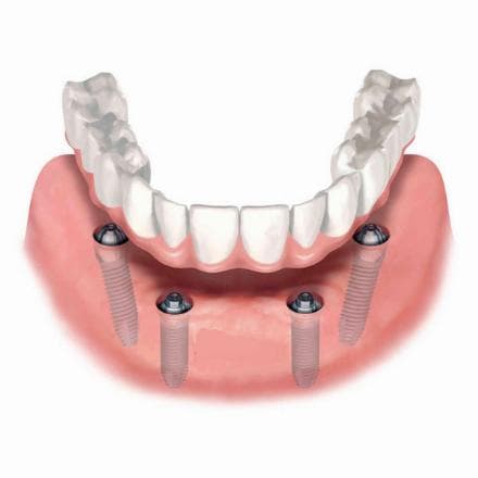 All on 4 (denti in ceramica)