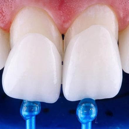 Faccette in composito realizzate in studio