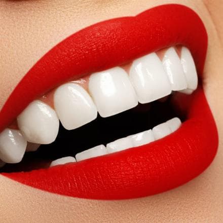 Hollywood smile (corone in ceramica, una mascella)