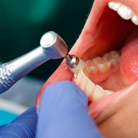 Rimozione del tartaro + lucidatura dei denti