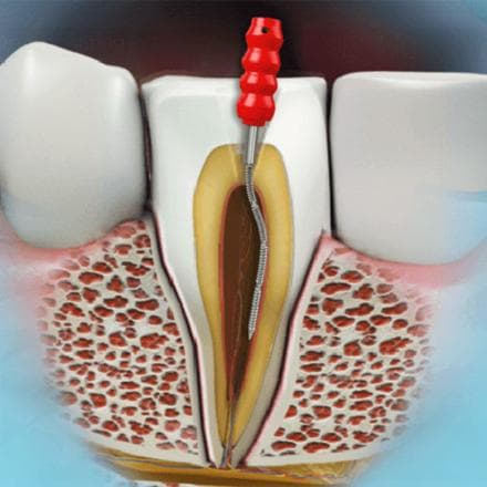 Trattamento endodontico di un dente vitale