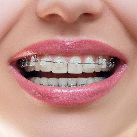 Damon apparecchio trasparente