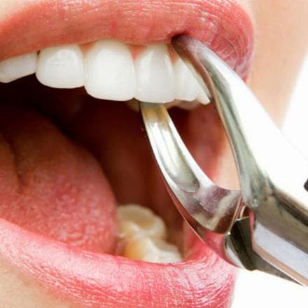 Estrazione del dente