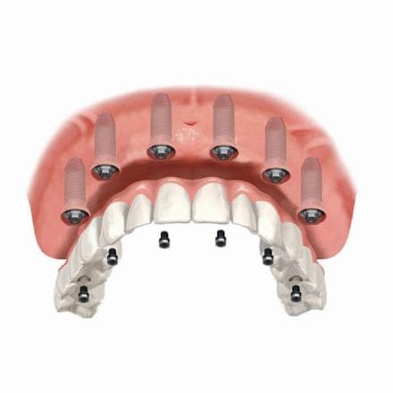 All on 6 (denti in ceramica)