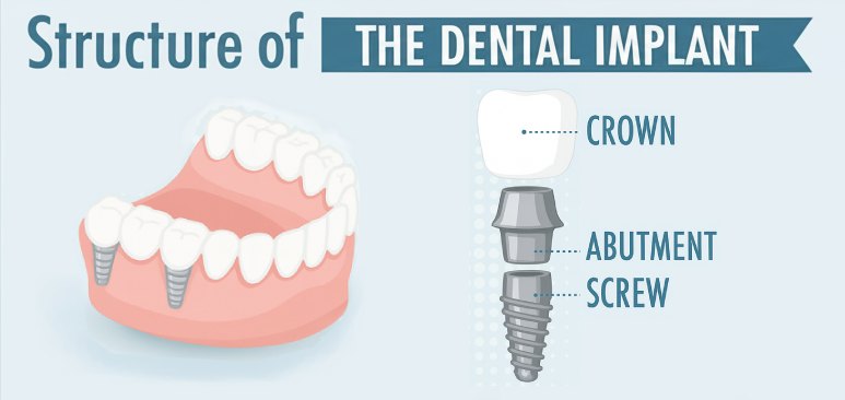 a detailed infographic about structure of dental implants listing all its componenets