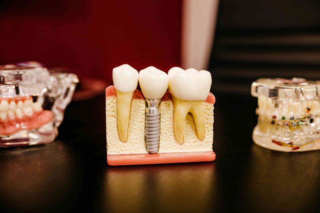 Dental implant model showing titanium screw with crown between natural teeth – example of modern implant dentistry