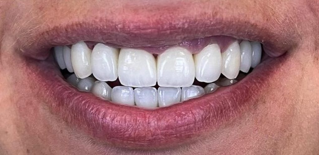 a close up of a person's mouth after dental treatment