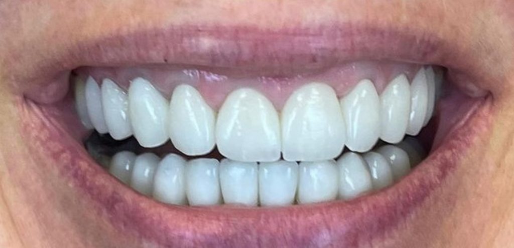 a close up of a person's mouth after dental treatment