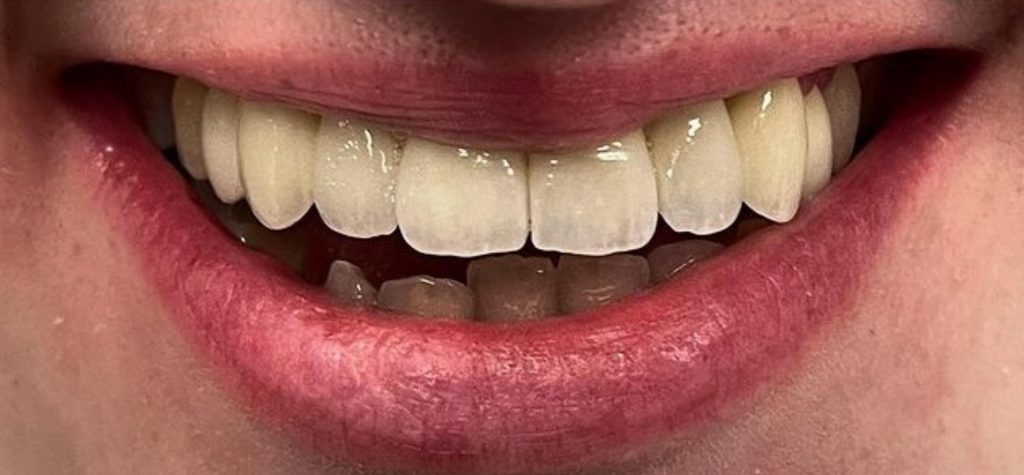 a close up of a person's mouth after dental treatment