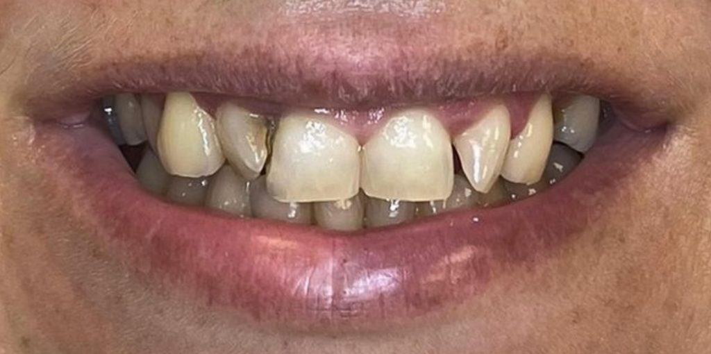 a close up of a person's mouth before dental treatment
