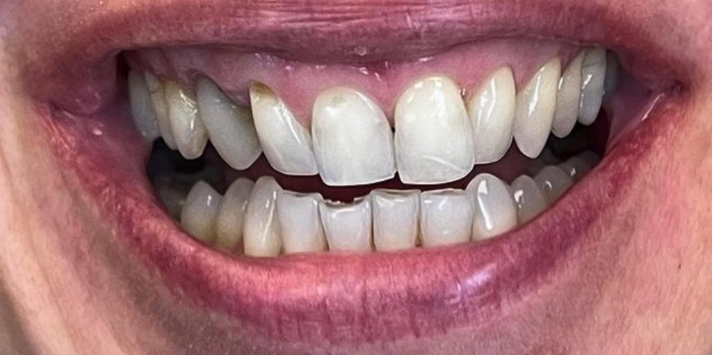 a close up of a person's mouth before dental treatment