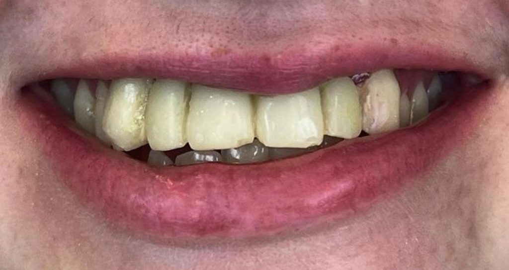 a close up of a person's mouth before dental treatment